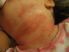 Atopic eczema