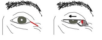 Prevention of avoidable blindness procedure diagram