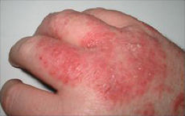 Atopic eczema