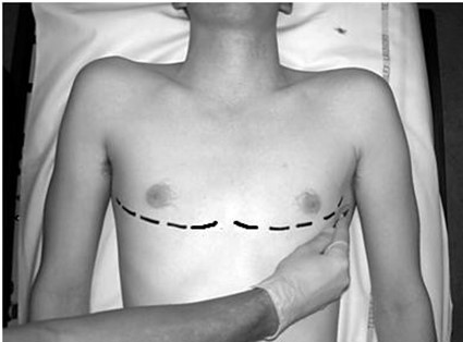 Patient marked for thoracotomy